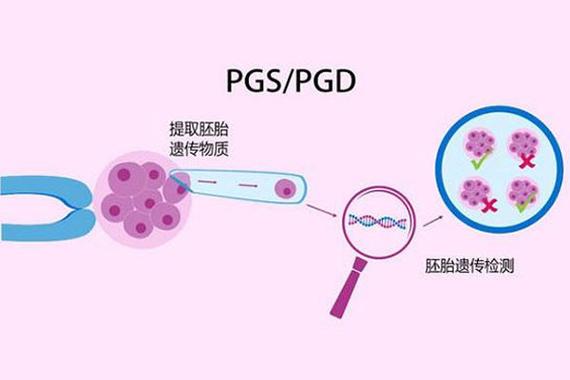 第三代试管婴儿 PGT